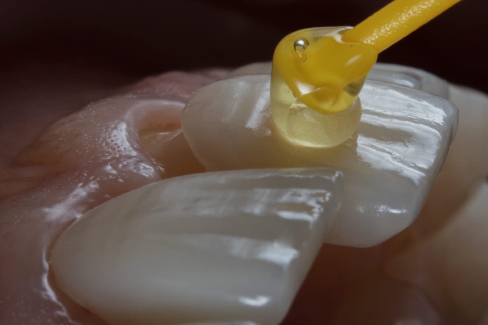 Veneers - Keramikschalen für perfekte Zähne