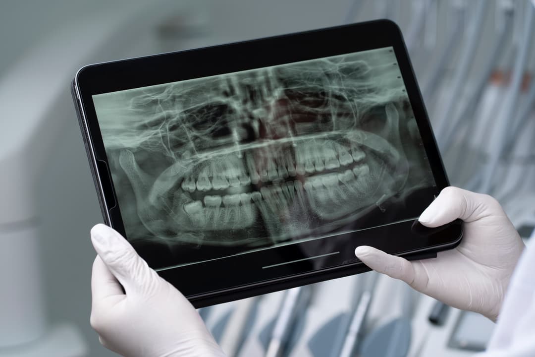 3D-Tomografie mit DVT - Digitale Volumentomographie